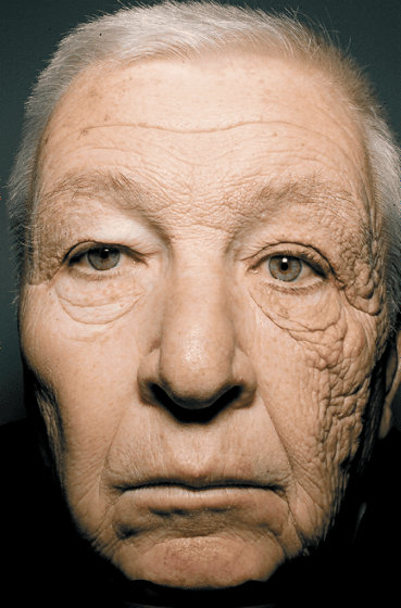 紫外線の肌への影響が如実に顔に表れた男性の画像