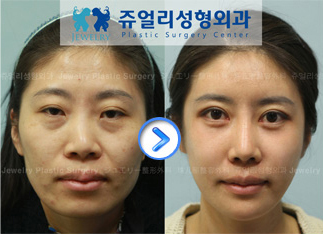 韓国の最新美容整形 ジュエリー整形外科