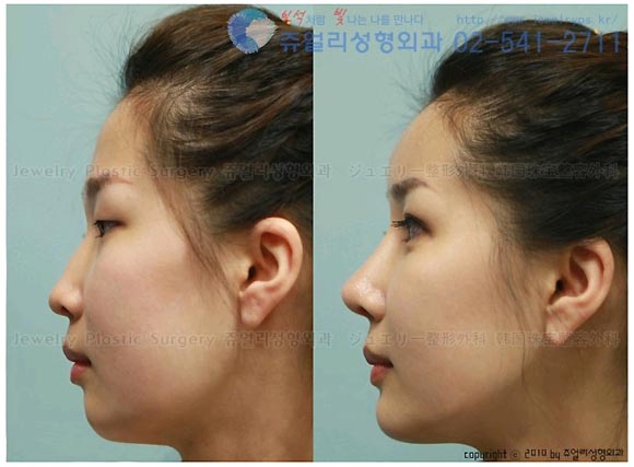 韓国の最新美容整形 ジュエリー整形外科